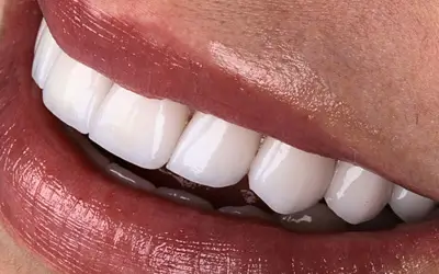 Royal Smile: planejamento inteligente para um sorriso natural e sofisticado